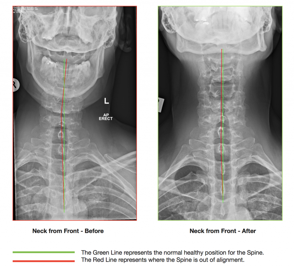 1610-lower-back-disc-injury-cx