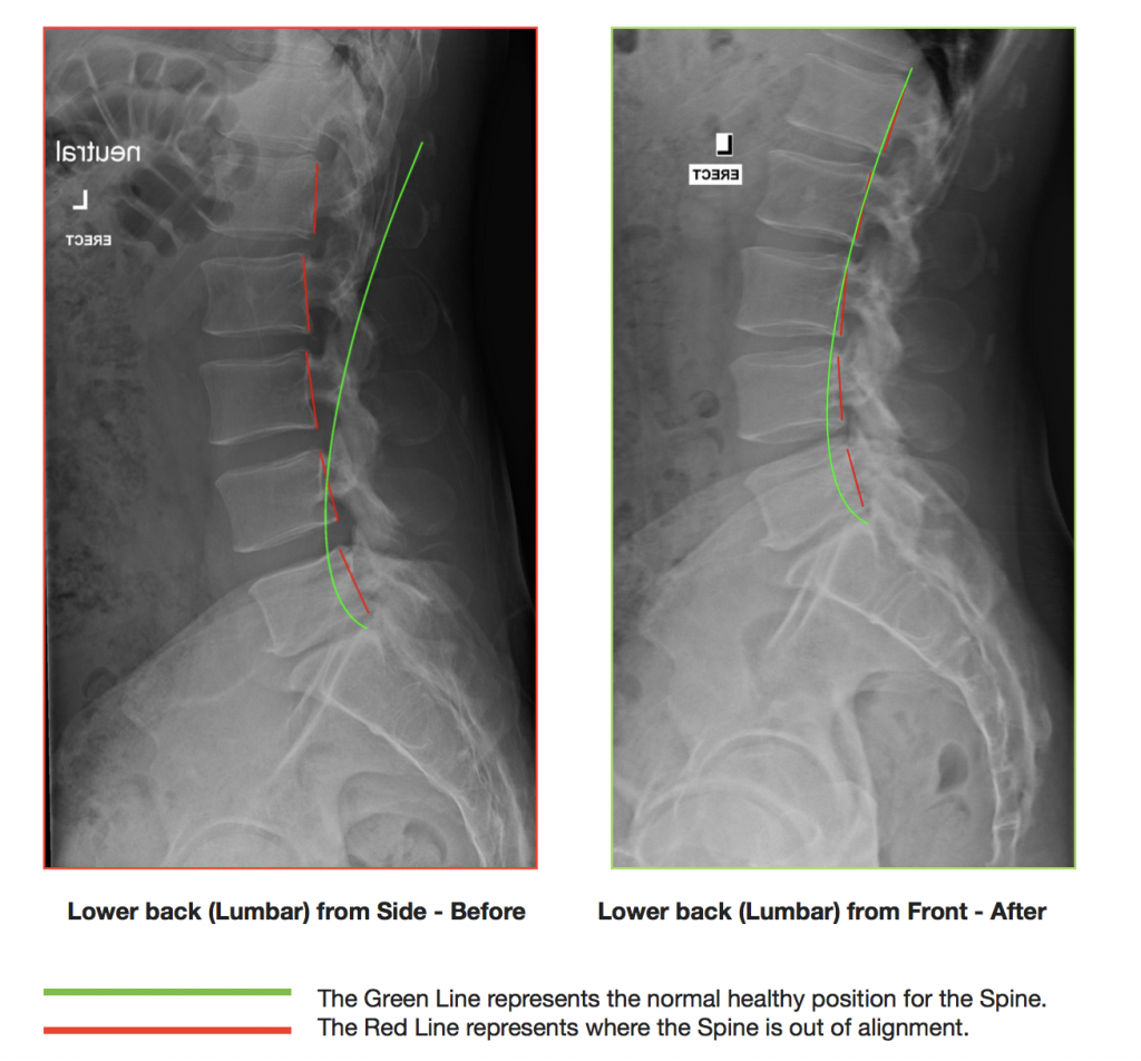 1610-lower-back-disc-injury-lsx