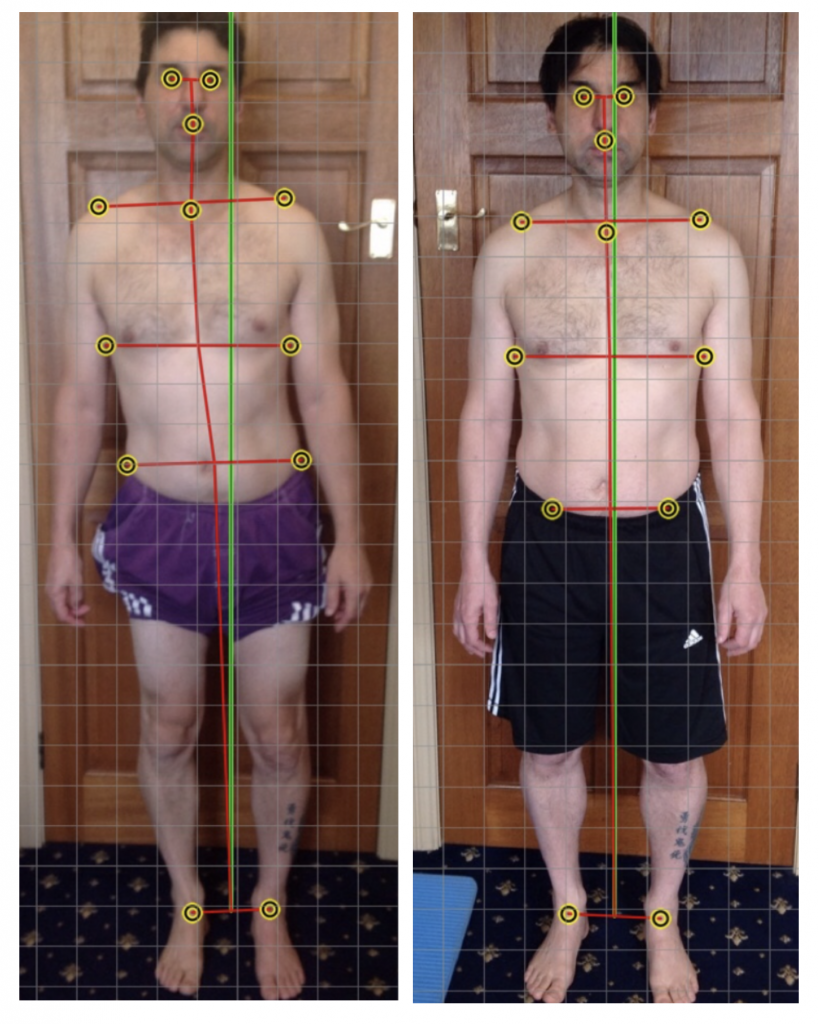 1610-lower-back-disc-injury-posture-screen