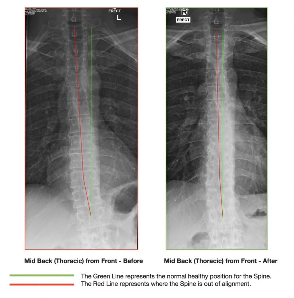 1610-lower-back-disc-injury-tx