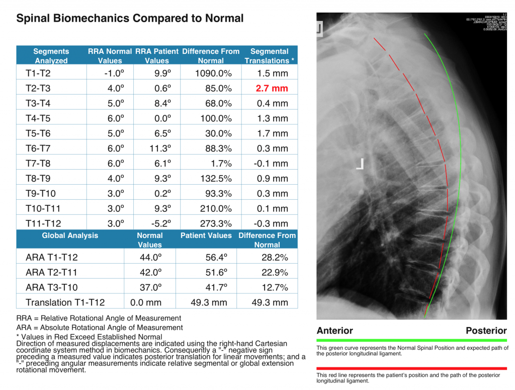 1909 Tx Kyphosis And Data