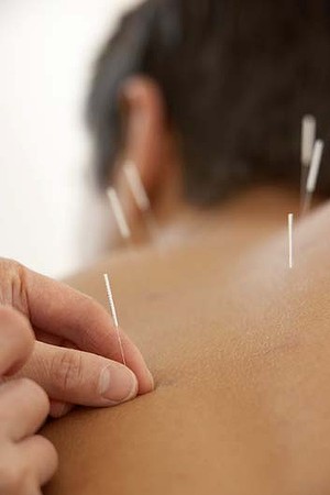 Acupuncture as good as drugs