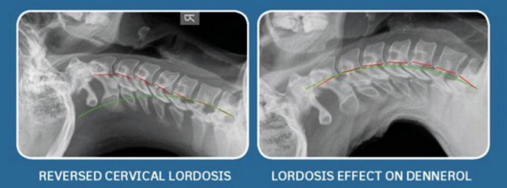 Cervical Correction On Denneroll