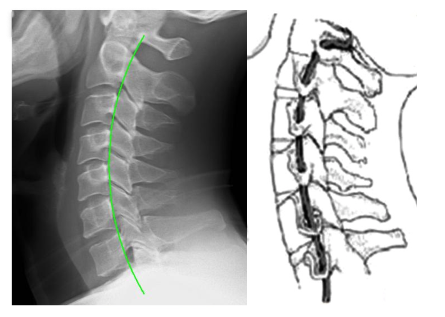 Normal Cervical Lordosis Art