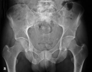 Hip Fractures