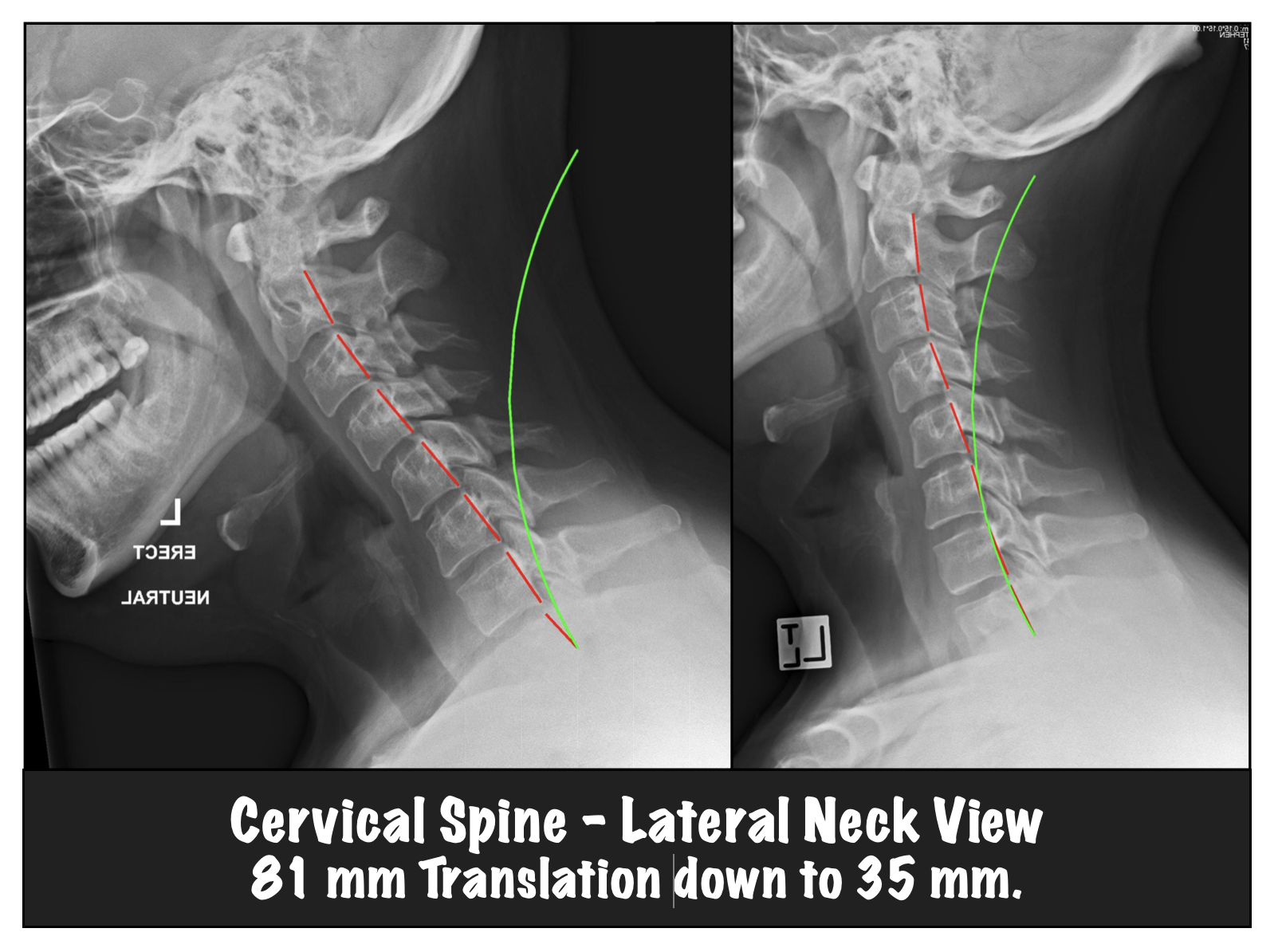 Lateral Cervical