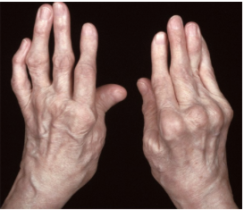 Rheumatoid Arthritis