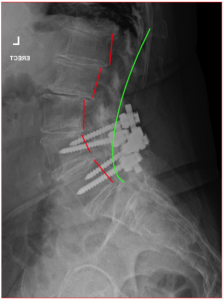 Failed Back Surgery