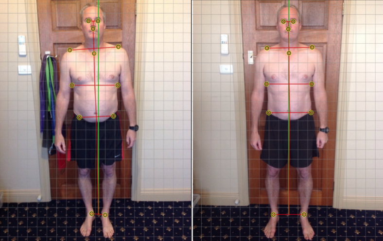 Case History: Chronic Back Pain and Forward Head Posture
