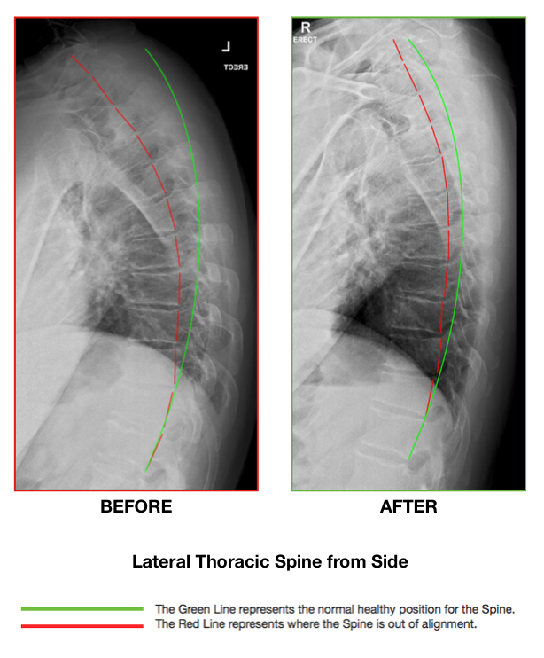 Case History: Chronic Back Pain and Forward Head Posture