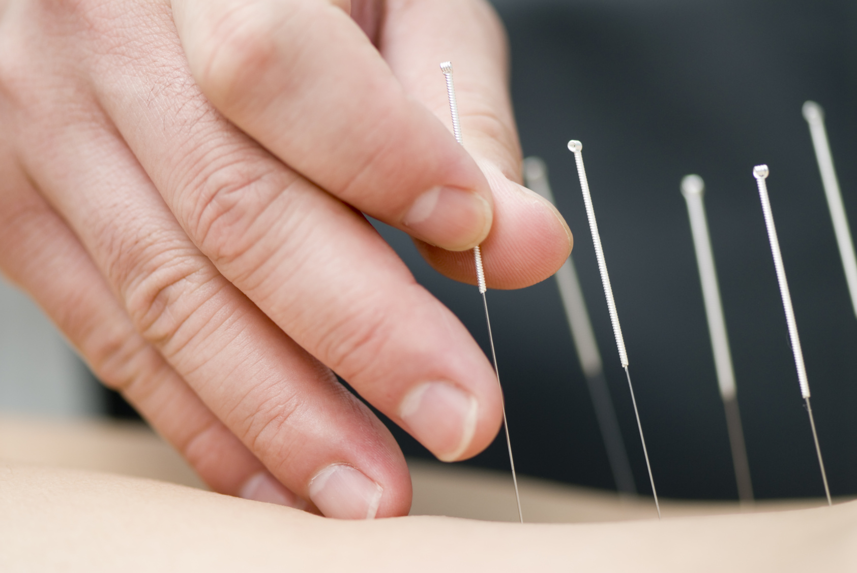 Acupuncture Cure Chronic Pain