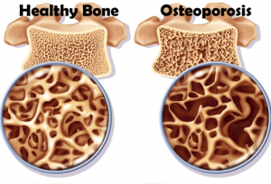 healthy-bone-
